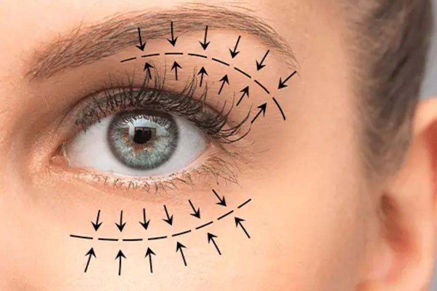 Upper and lower eyelid lift